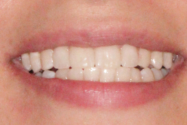 نمونه بعد درمان زیبایی دندان