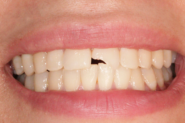 نمونه قبل درمان زیبایی دندان