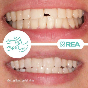 نمونه قبل و بعد درمان زیبایی دندان
