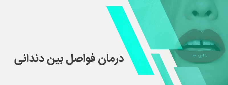 بنر مربوط به درمان فواصل بین دندانی