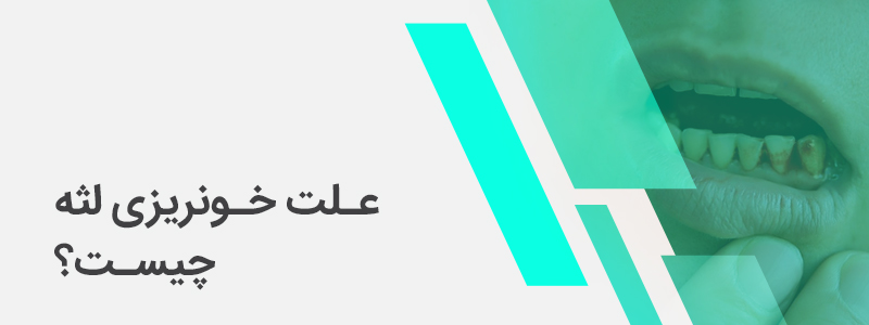 بنر مربوط به علت خونریزی لثه چیست؟