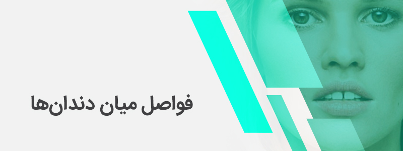 بنر مربوط به فواصل میان دندان‌ها