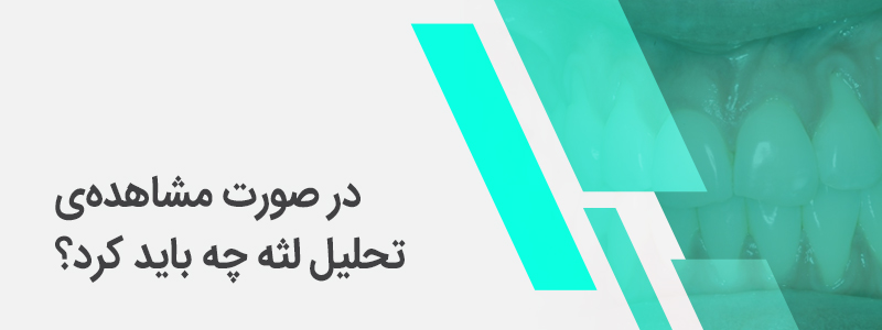 نبر مربوط به در صورت مشاهده‌ی تحلیل لثه چه باید کرد؟