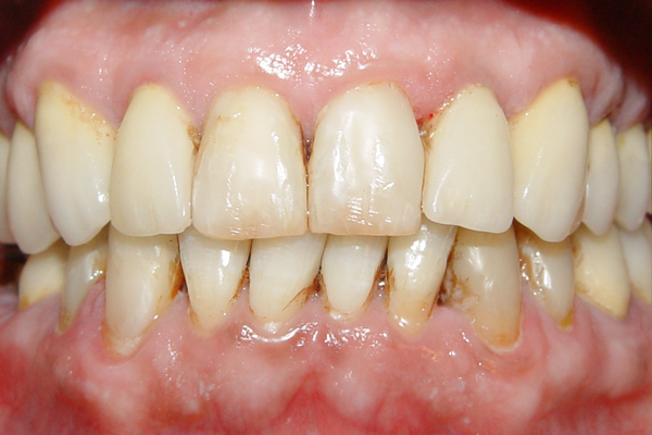 نمونه بعد جراحی بازسازی لثه-روکش و لمینیت کامپوزیت