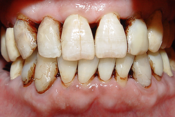 نمونه قبل جراحی بازسازی لثه-روکش و لمینیت کامپوزیت