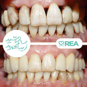 نمونه قبل و بعد جراحی بازسازی لثه، روکش و لمینیت کامپوزیت