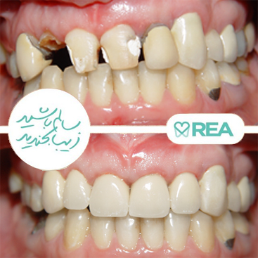 نمونه قبل و بعد بازسازی دندان‌های تخریب شده و روکش بدون کشیدن دندان‌ها