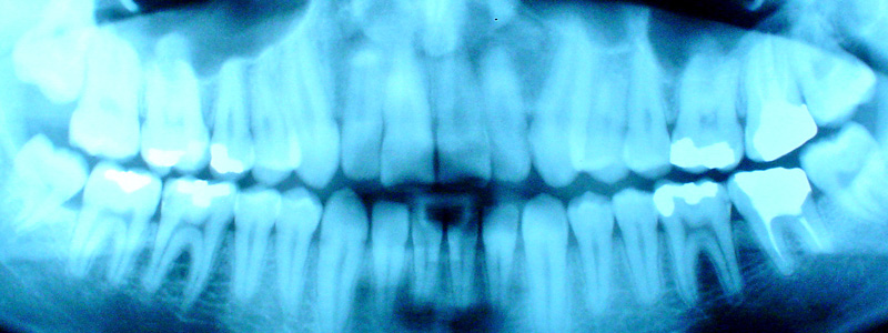 رادیوگرافی (عکس ایکس-ری) دندان