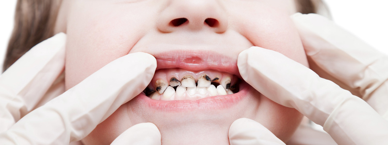 بیماری‌های شایع که باعث پوسیدگی دندان‌ می‌شود