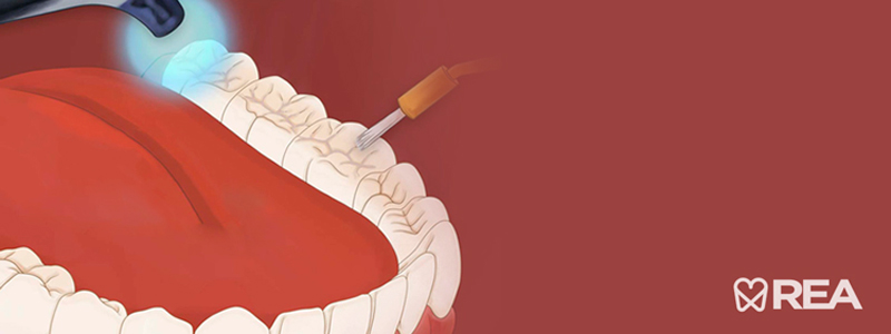 سیلانت دندان – روشی بسیار موثر برای مهار پوسیدگی دندان