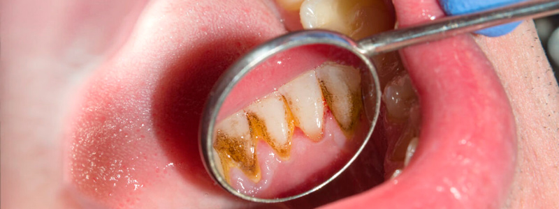 از بین بردن پلاک و تارتار از روی دندان‌ها
