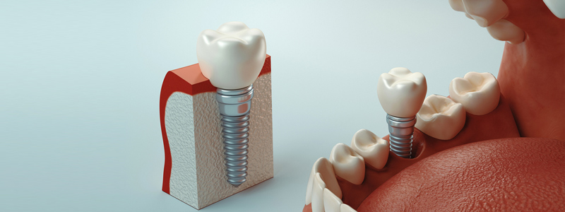 سه نوع ایمپلنت دندان (روش مناسب برای شما)