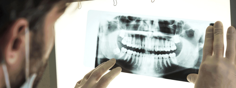 CBCT - چرا گاهی رادیوگرافی استاندارد کافی نیست