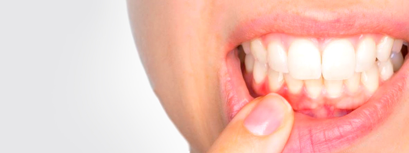 تحلیل دندان - داخلی و خارجی: علل، علائم و درمان