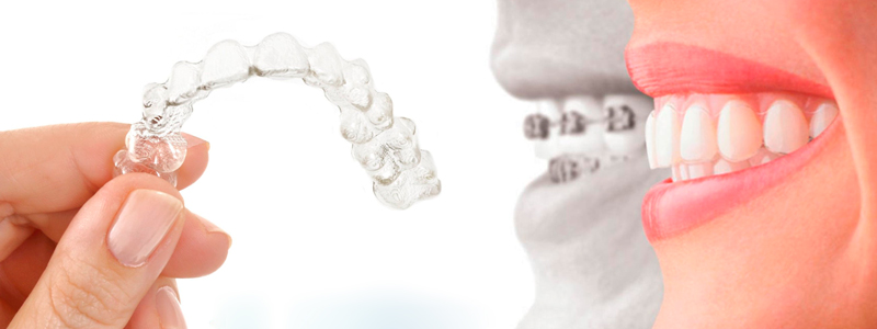 سفید کردن دندان‌ها: قبل یا بعد از ارتودنسی نامرئی