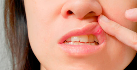  همه‌چیز در مورد زخم‌های دهان - علل و درمان