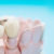 ایمپلنت فول موس - نحوه درمان، مزایا و هزینه ایملپنت کامل دهان