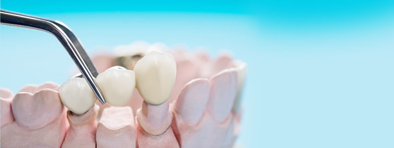 ایمپلنت فول موس - نحوه درمان، مزایا و هزینه ایملپنت کامل دهان