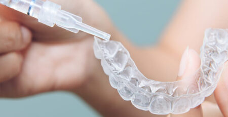 بلیچینگ دندان: آشنایی با انواع روش‌ها و مراحل سفید کردن دندان
